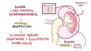 Hydronephrosis  Renal Pathology  Osmosis [upl. by Sitoeht247]