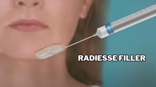 Radiesse Filler per Lifting non Chirurgico [upl. by Maxie]