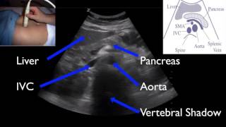 Aorta Exam AAA POCUS [upl. by Nitas968]