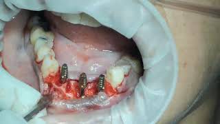 failed bone grafting and splinting  lower front teeth extraction  and immediate implant surgery [upl. by Neirrad]