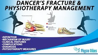 DANCERS FRACTURE amp PHYSIOTHERAPY MANAGEMENT [upl. by Adara494]