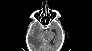 Radiology Class 1 CT Scan Post Fossa Ventricles Herniations [upl. by Yorgos649]