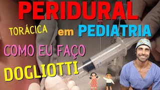 ANESTESIA PERIDURAL em PEDIATRIA  Técnica Segura [upl. by Schuh]