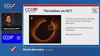 Intrav Imaging in MINOCA When to Use Index of Microcirculatory Resistance IMR Shrilla Banerjee MD [upl. by Ybanrab578]