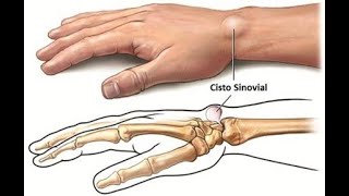 CISTO SINOVIAL  TRATAMENTO [upl. by Kcirddahc137]