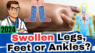 1 Cause of Swollen Ankles Legs or Feet What Causes It Dangers [upl. by Tabor]