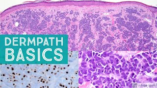 Basic Dermpath Cases  Explained by a Dermatopathologist [upl. by Atnahsa]