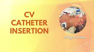 Central Venous Catheter 4FG insertion to 17Kg Preterm neonate [upl. by Quiteri604]