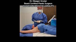 AWAKE MINI BRACHIOPLASTY ARM LIFTSubtitles by Dr Meegan Gruber Board Certified Plastic Surgeon [upl. by Otrepur586]