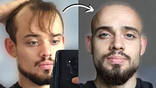 100 BALDING MEN BeforeAfter SHAVING HEAD BALD 2 [upl. by Leilah]