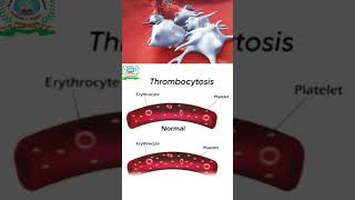 Thrombocytopenia  Thrombocytosis  Their symptoms  Treatment [upl. by Nomled244]