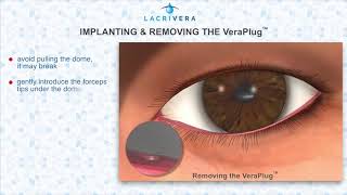 Punctal Plugs For Dry Eye [upl. by Learrsi]