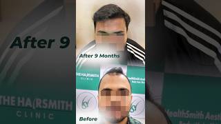 Hair Transplant Result in 9 Months  The Hairsmith Clinic shorts beforeandafter hairtransplant [upl. by Anirtap456]