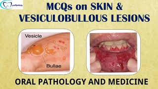 MCQs on Skin and Vesiculobullous lesions  Oral pathology and medicine  Dentophile [upl. by Glad]