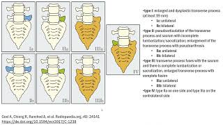 Castellvi classification of lumbosacral transitional vertebrae [upl. by Aekan]