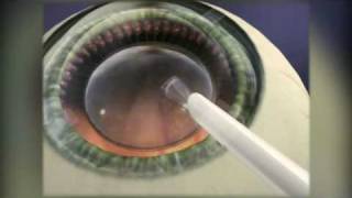 Implantable Contact Lens [upl. by Mohammad225]