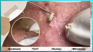 Big Cystic Acne Blackheads Extraction Blackheads amp Milia Whiteheads Removal Pimple Popping [upl. by Ardnazxela]