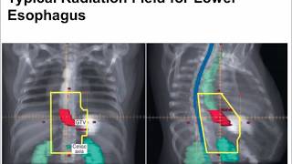 esophagus cancer radiation [upl. by Raviv802]