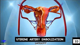 Uterine Artery Embolization  Tumor Cell Removing Surgery [upl. by Ginsberg]