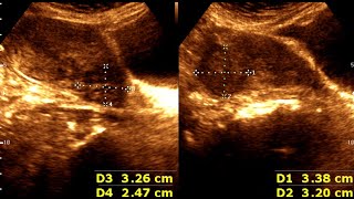 Three cases of Leiomyoma Uterus  Abnormal Uterine Bleeding  sonographic prediction [upl. by Ayitahs]