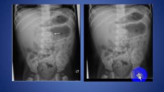 Pediatric Intussusception [upl. by Enirahtac614]