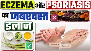 सोरायसिस और एक्जिमा को ठीक करने का जबरदस्त तरीका  Eczema Psoriasis Difference  Eczema ka ilaj [upl. by Alissa]