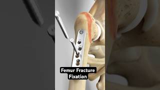 Femur Fracture Fixation Dynamic Hip Screw Method [upl. by Mariejeanne]