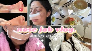 I GOT A RHINOPLASTY IN MEXICO [upl. by Lavelle737]