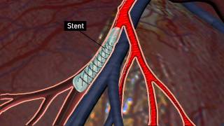 Whats a stent [upl. by Adnolrehs465]