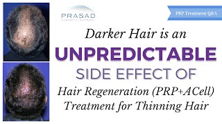 Darker Hair is a Side Effect of PRPACell Hair Loss Treatment but an Unpredictable Side Effect [upl. by Kcirrek]