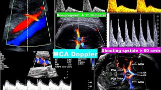 lecture 15 Doppler in Obstetrics [upl. by Waltner763]