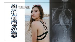 脊椎侧弯分享 My Scoliosis Story  StephyYiwen [upl. by Namruht]