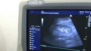 Ge Logiq S6 Shared Service Ultrasound [upl. by Sille]