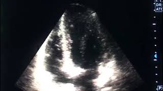 Myocarditis and echocardiographydrahmadmirdamadisiRSay4FU8O1HxWfD9 [upl. by Ahsilaf]