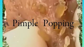 Pimple amp Blackheads Popping  38 [upl. by Ewald467]