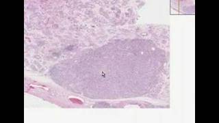 Histopathology TestisSeminoma [upl. by Haskins]