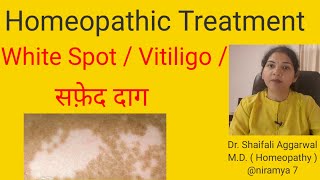 White spot Vitiligo सफ़ेद दाग Homeopathic Treatment for White spot  Vitiligo सफ़ेद दाग [upl. by Nirre]