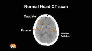 Normal Head CT Scan Anatomy Made Simple Neuroradiology [upl. by Fitzgerald400]