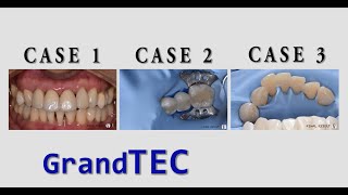 Intra amp Extra Coronal Splinting in Periodontal Treatment❗ Glass Fiber Reinforced Composite GrandTEC [upl. by Oihsoy664]