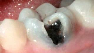 Crowns Large Cavity Diagnosis [upl. by Lanta]