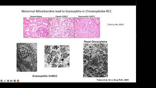 Lisa Henske Chromophobe RCC [upl. by Saxen669]