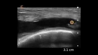 Knee Effusion Ultrasound Image Interpretation [upl. by Haelak]