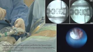 II TELA  Transforaminal Epiduroscopic Laser Annuloplasty   full procedure [upl. by Tezzil]