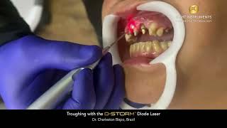 Troughing with the DStorm™ Diode Laser [upl. by Dhruv924]