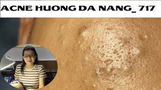 Acne Treatment Huong Da Nang 717  Remove Blackheads [upl. by Foskett]