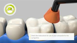 Stepbystep intraoral repair of zirconiabased restorations with iBOND Universal EN [upl. by Faith217]