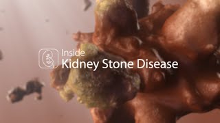 Medical Animation Kidney Stone Disease [upl. by Emmalyn784]