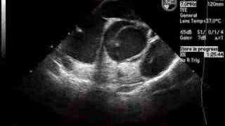 Dissection of Ascending Aorta on Echocardiogram [upl. by Rhodia758]