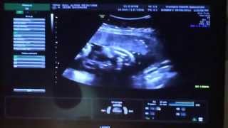 34 weeks and 3 days pregnant ultrasound [upl. by Lanuk]