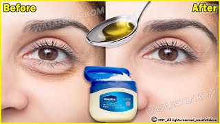 In 3 days Remove Under Eye Bags Completely  Remove Dark Circle Wrinkles Puffy Eyes [upl. by Akiehs]